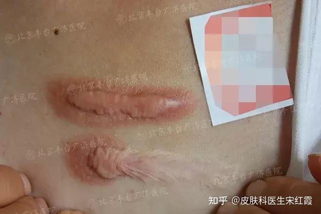 疤痕增生能看皮肤科吗女（疤痕增生能看皮肤科吗女性） 疤痕增生能看皮肤科吗女（疤痕增生能看皮肤科吗女性）《疤痕增生可以看皮肤科吗》 女科知识