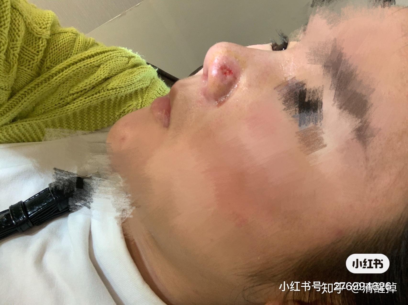 12号做的鼻子,效果先不说,鼻翼两侧给我放了个东西,结果导致肉烂了,有