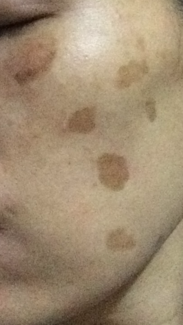 s:咖啡色斑的位置,皮肤是比正常肤色的皮肤稍微凹下去一点点,除颜色是