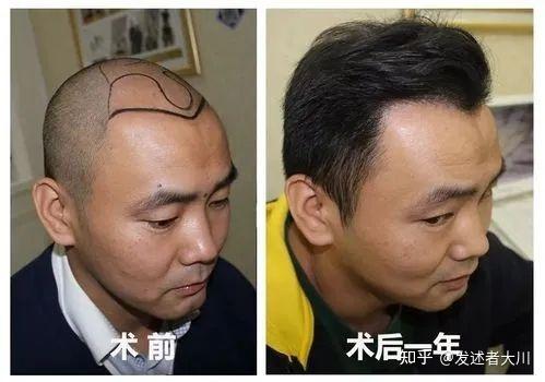 整条植发技术(整条植发技术怎么样)