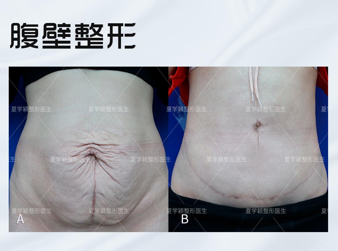 产后腹部塑形只吸脂就够了吗省妇幼医生告诉你答案
