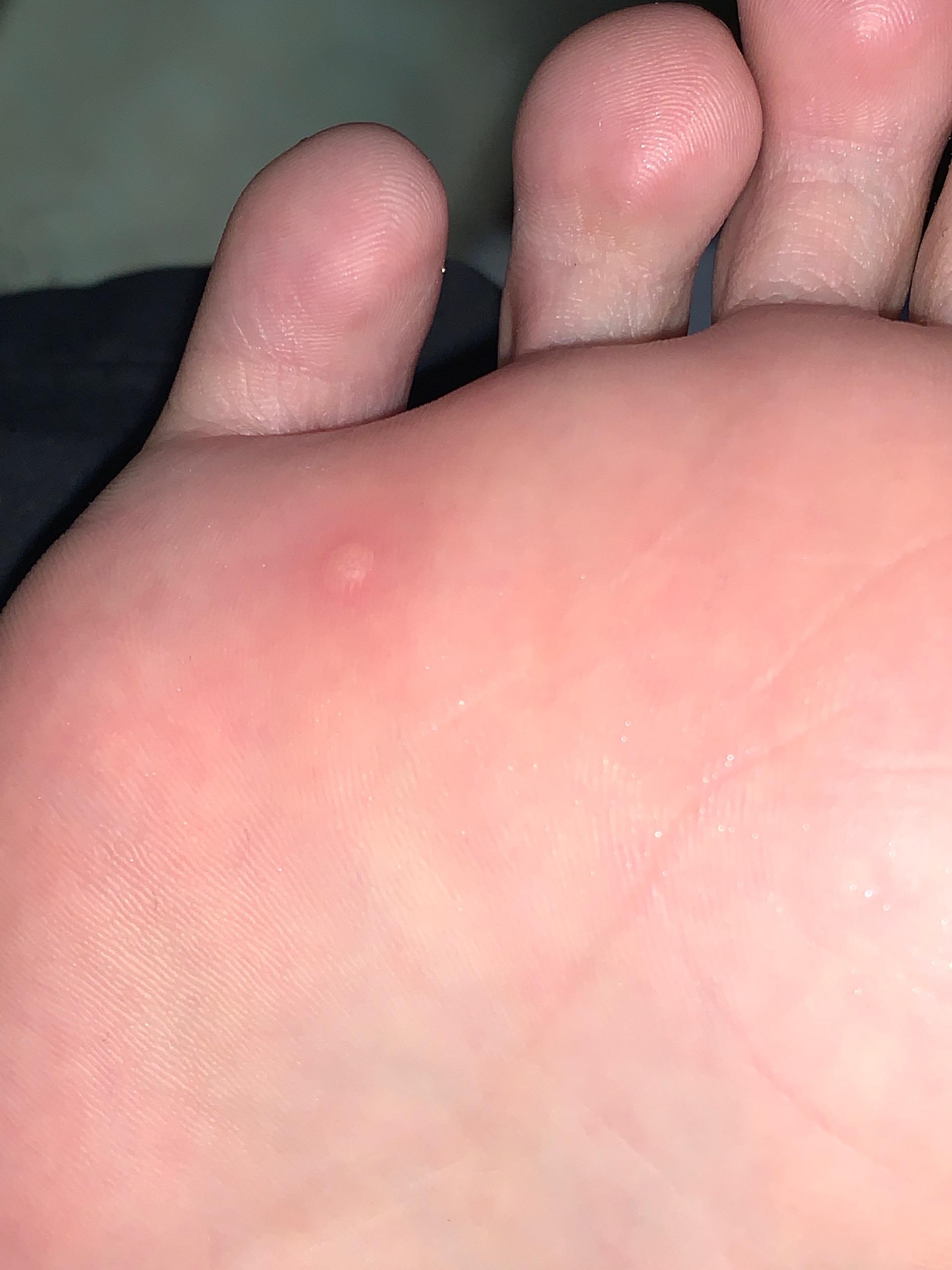 冷冻跖疣过程记录