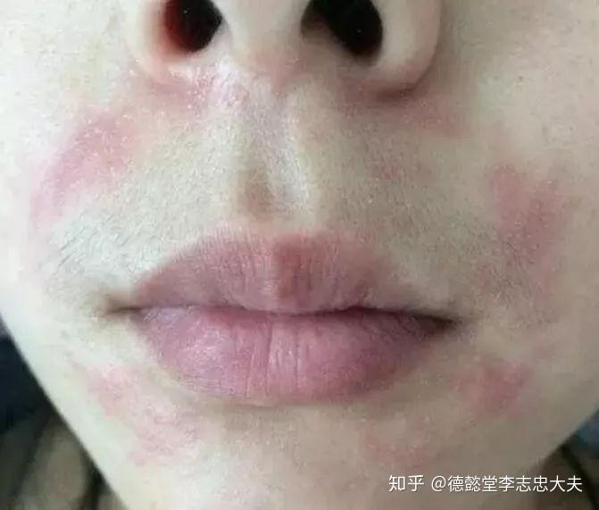 嘴巴一圈发红长疙瘩、脓疱？小心口周皮炎来袭！ - 知乎