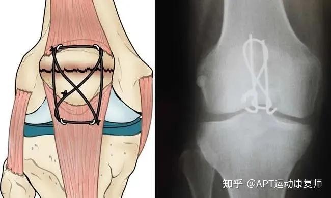 精選案例髕骨粉碎性骨折術後8周靜養不能正常行走康復介入不到兩個月