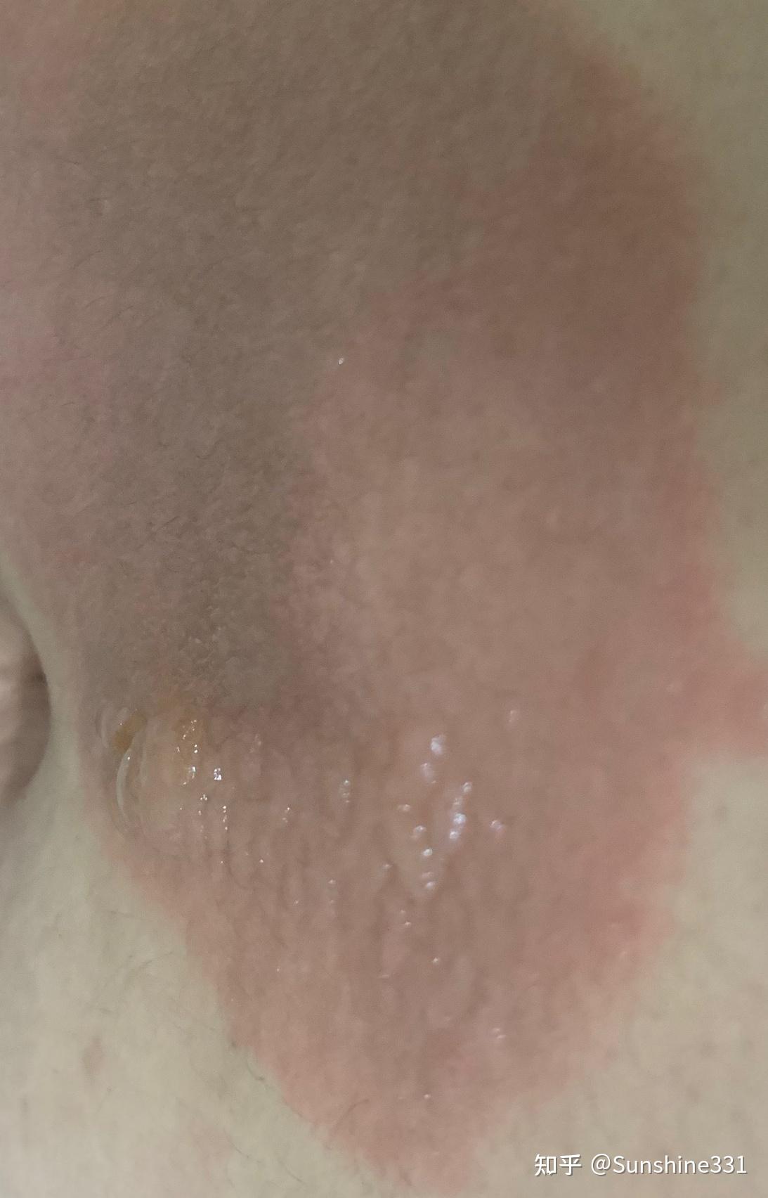 二度烫伤恢复过程记录