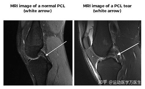 后交叉韧带撕裂了该怎么办？ - 知乎