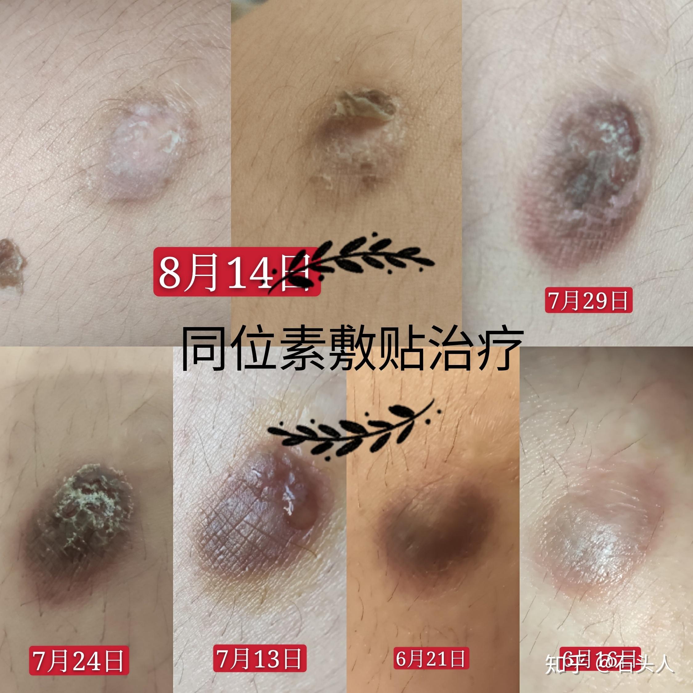 记录同位素治疗瘢痕疙瘩