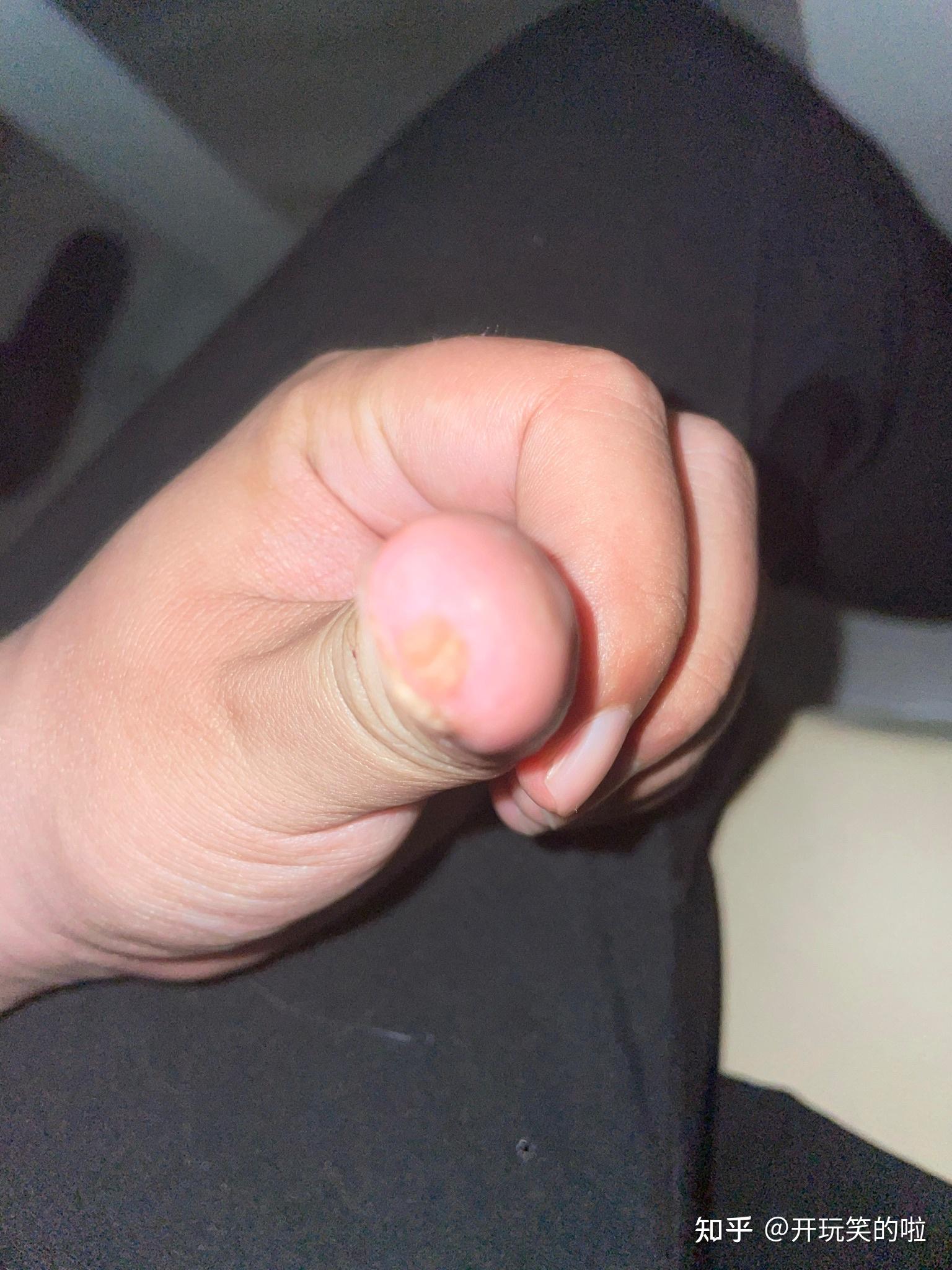 震惊我的两年甲周疣终于好了不冷冻不激光