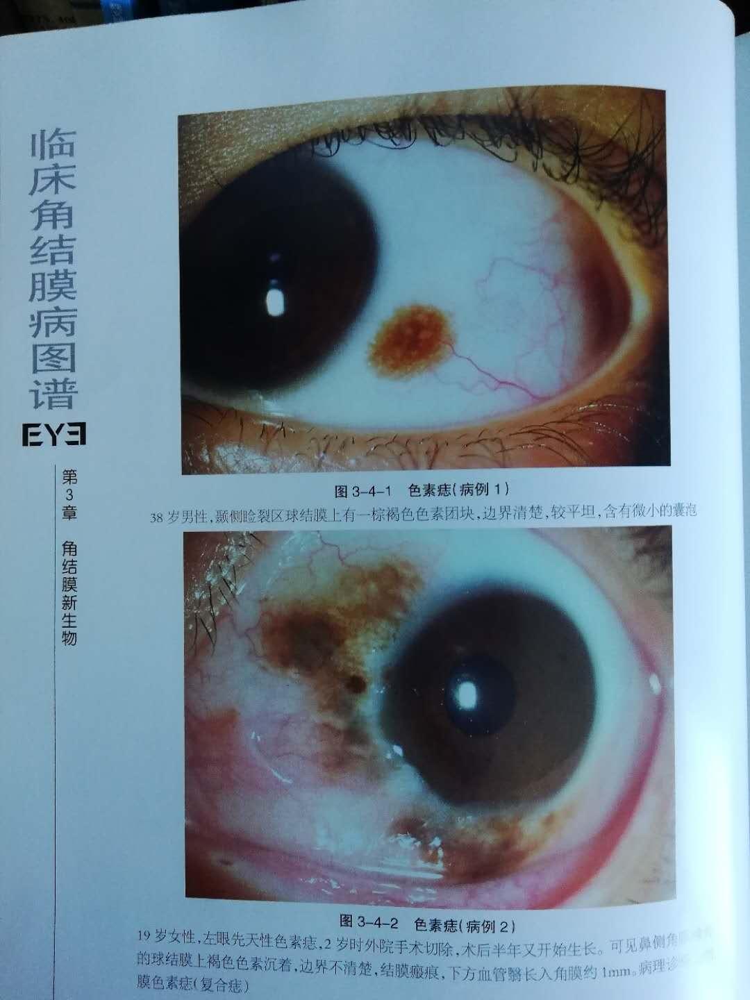 左眼—结膜色素痣手术自述 - 知乎