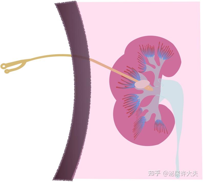 肾造瘘管示意图图片