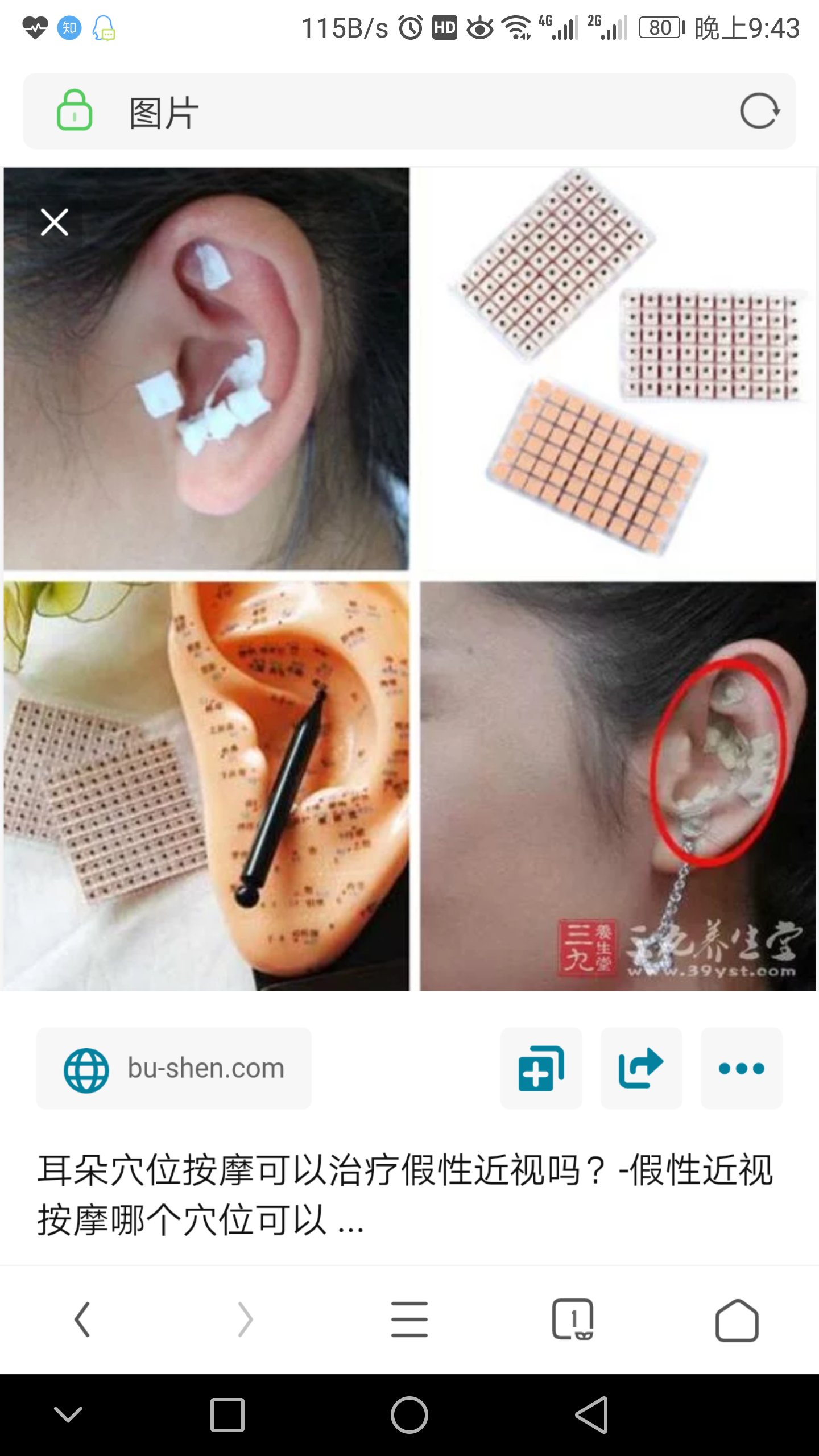 这时候一群专家横空出世,以穴位压豆法治疗近视,耳穴压豆是重灾区,不