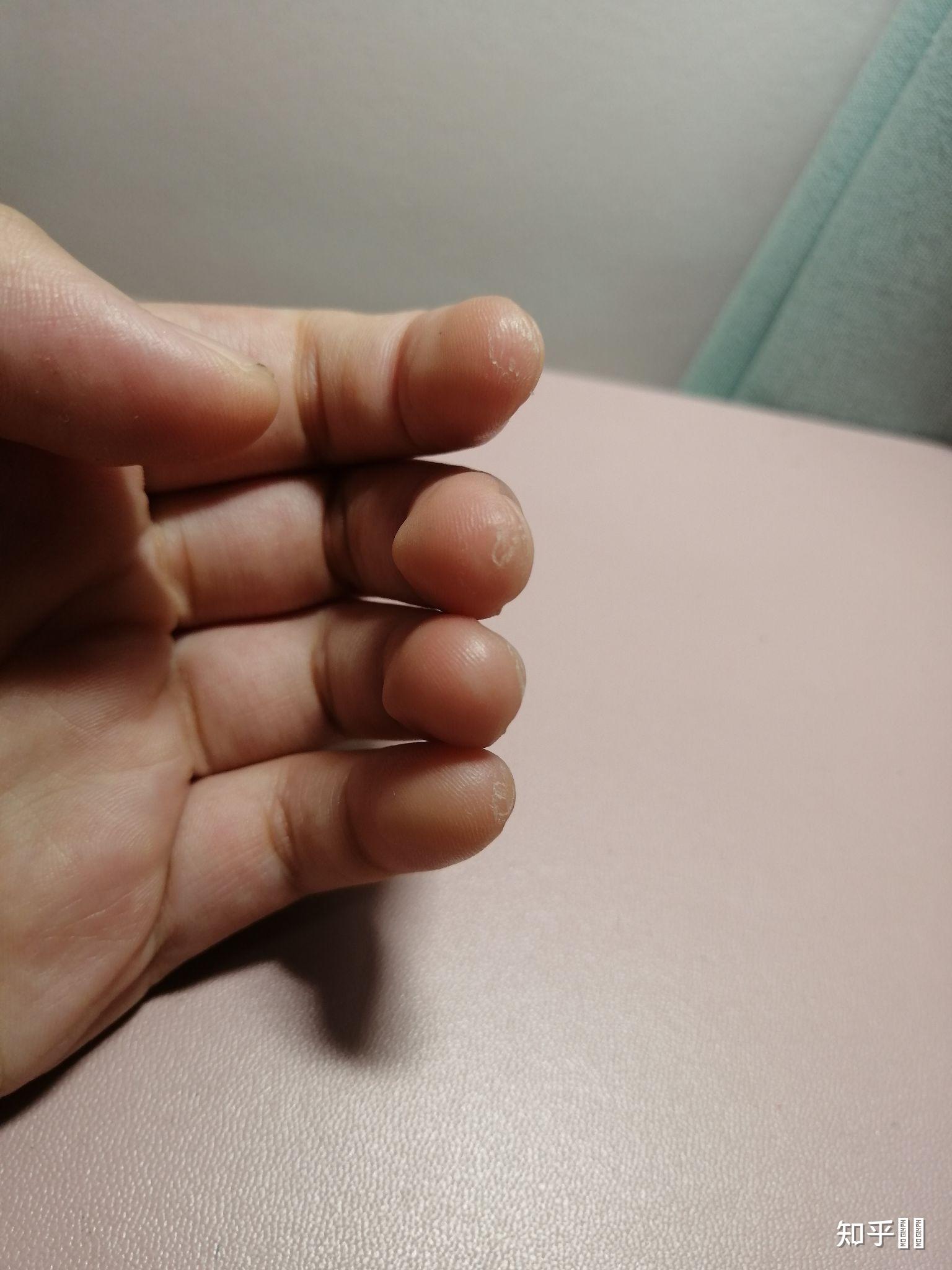 大家弹吉他的手指都是什么样的? - 知乎