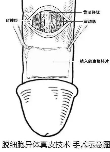 丁丁背神经隔离术是什么?