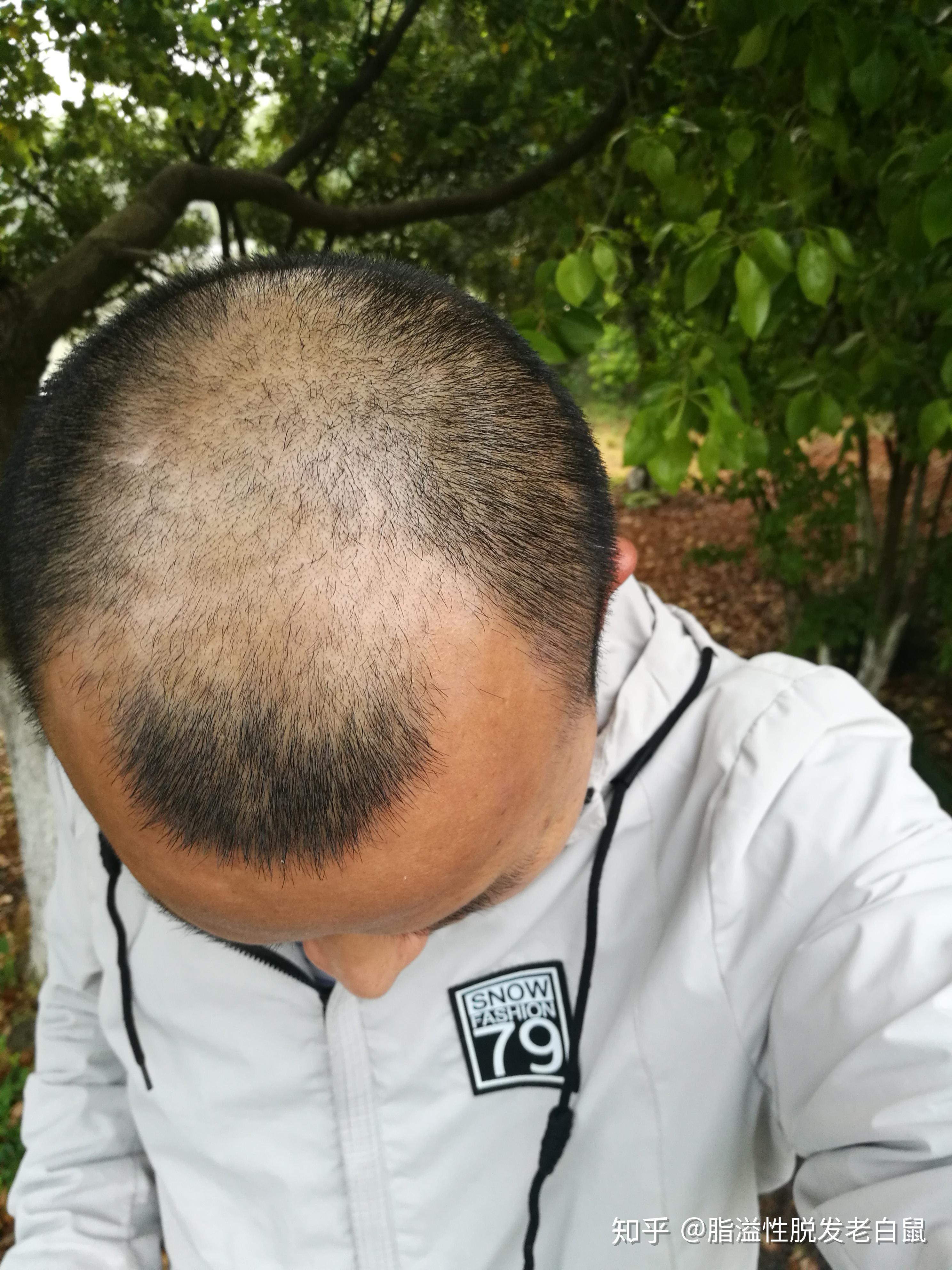 自我判断脱发等级程度(我是五级)