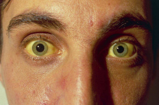 肝藏血,呈现肝容主要表现为肝斑,痤疮,脸色发黄,黑眼圈,并且肤色暗淡