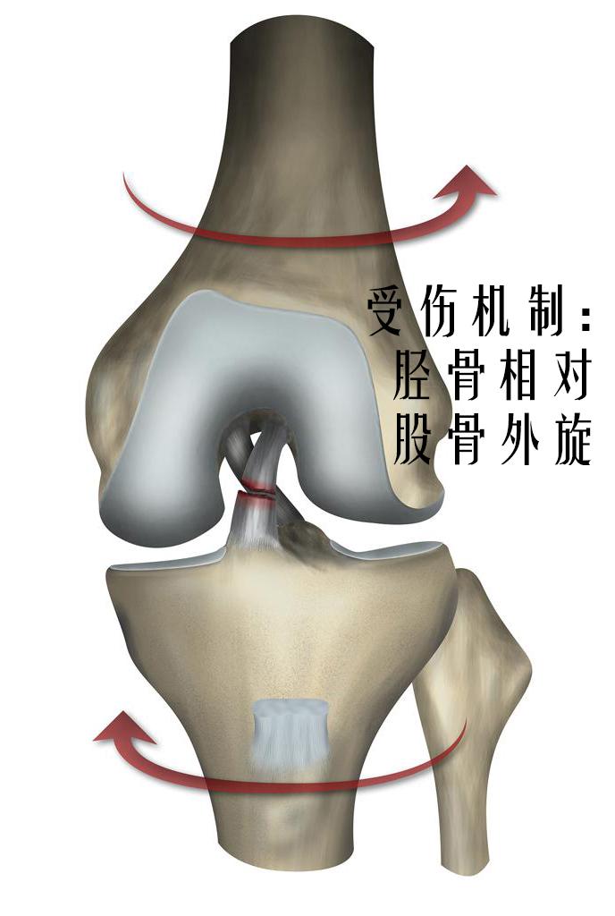 前交叉韧带撕裂了该怎么办 知乎 前交叉韧带撕裂了该怎么办 知乎