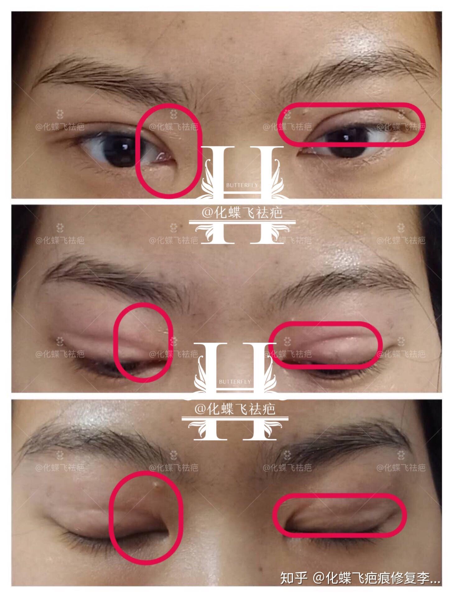 双眼皮增生疤痕能治疗修复吗?