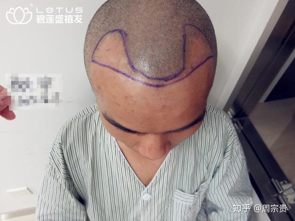 从额角开始的脱发,为什么那么难发现? - 知乎