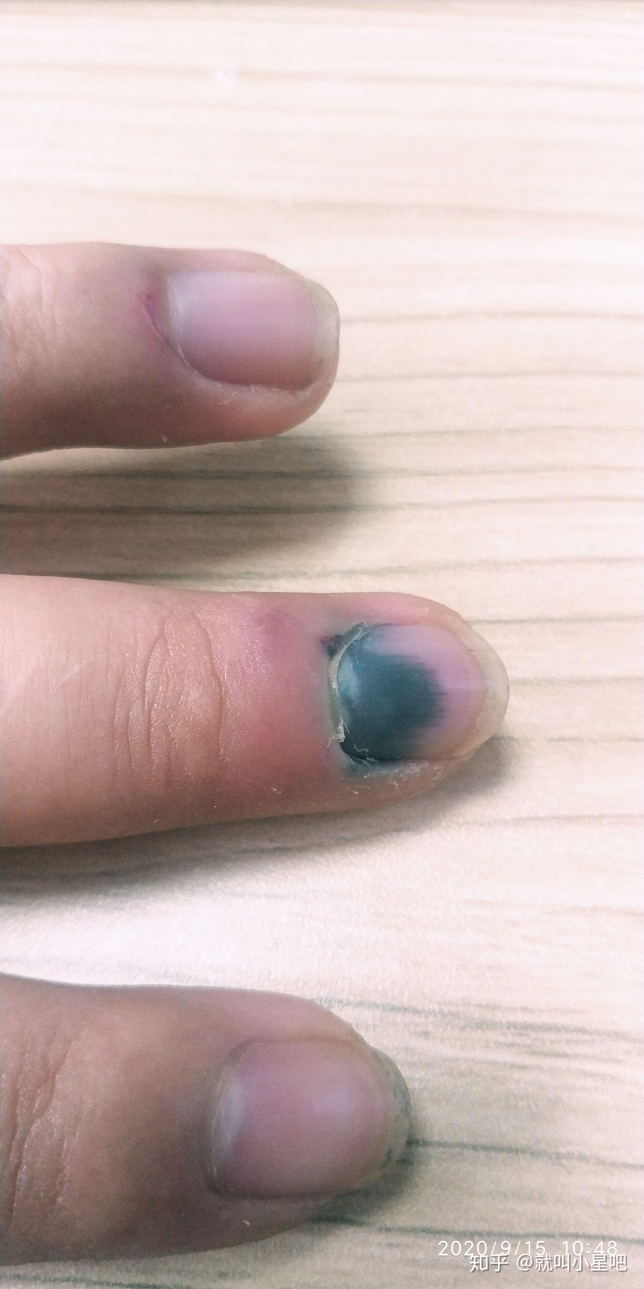 指甲被砸到了记录恢复过程