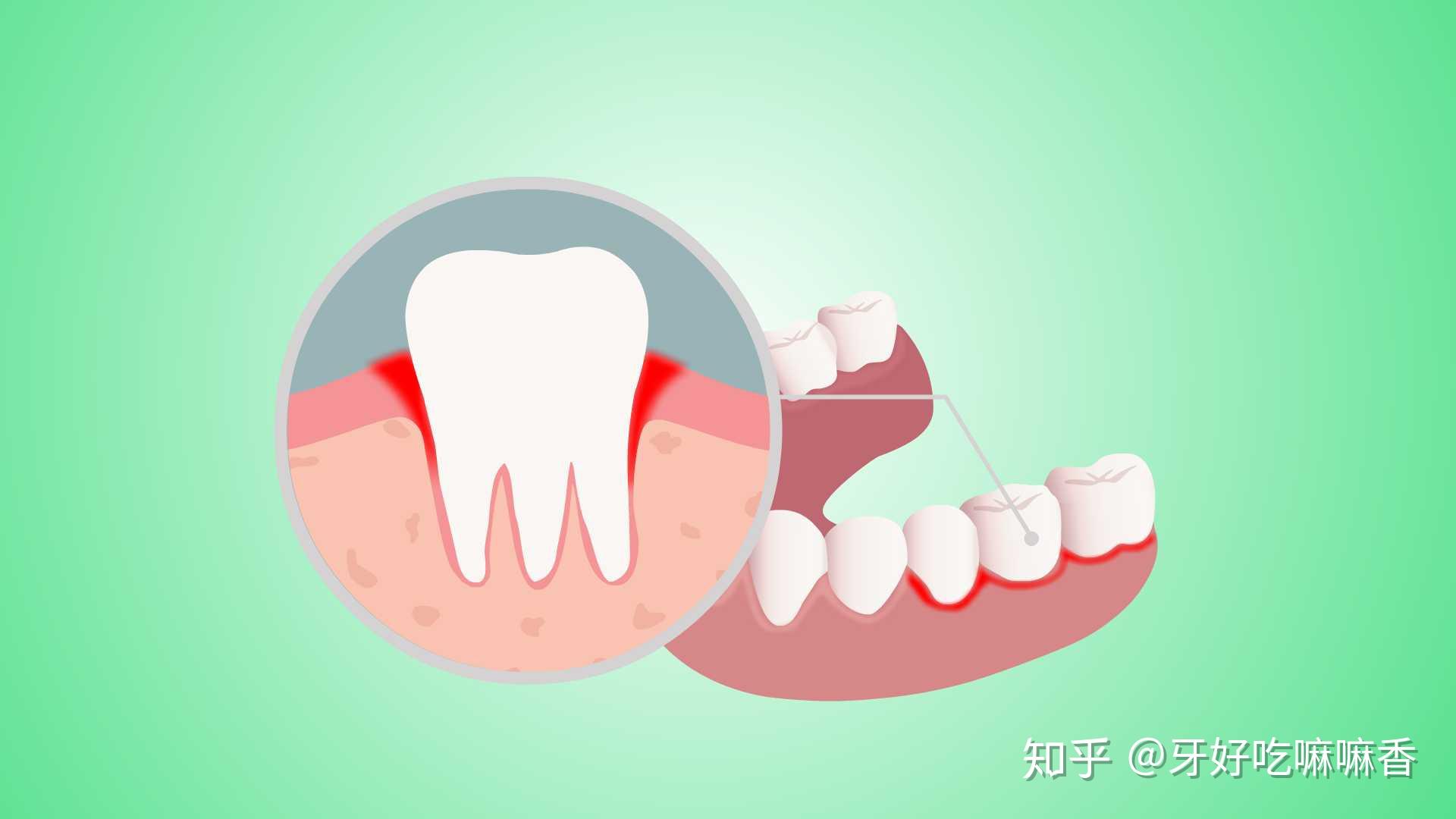 牙结石有什么危害？ - 知乎