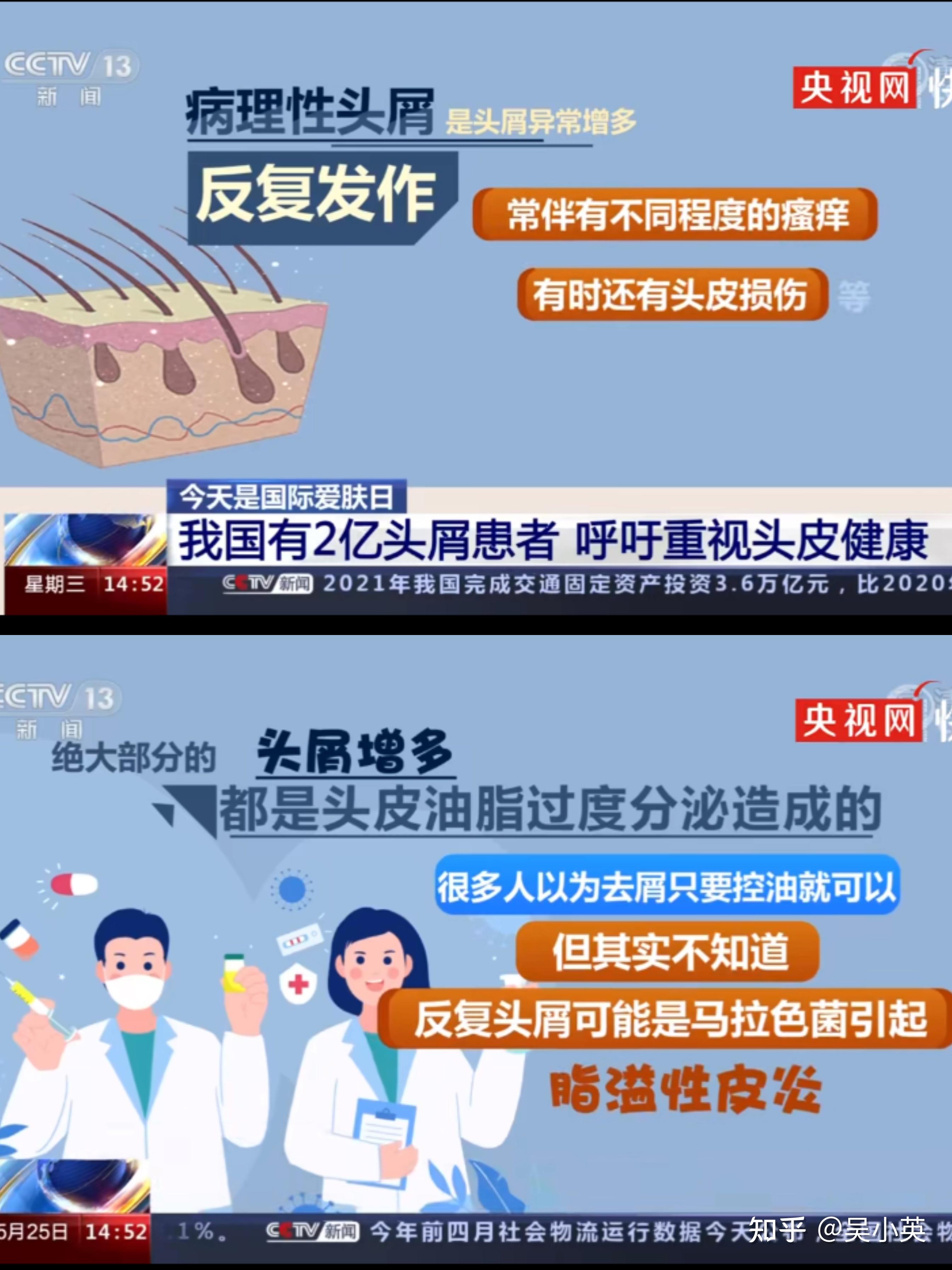关于脂溢性皮炎的一些想法(本人油头) - 知乎