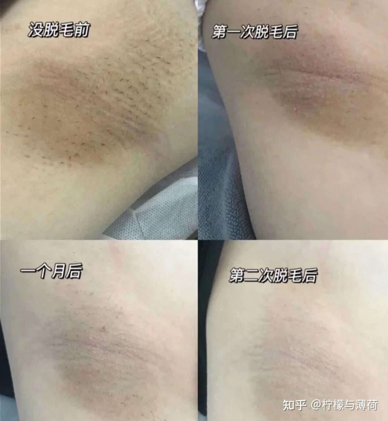 真消费才敢说真话,真人测评脱毛仪腋下/比基尼/大腿/手臂脱毛!家用脱毛仪是否可以干净利落的脱毛呢?(内附对比照) - 知乎