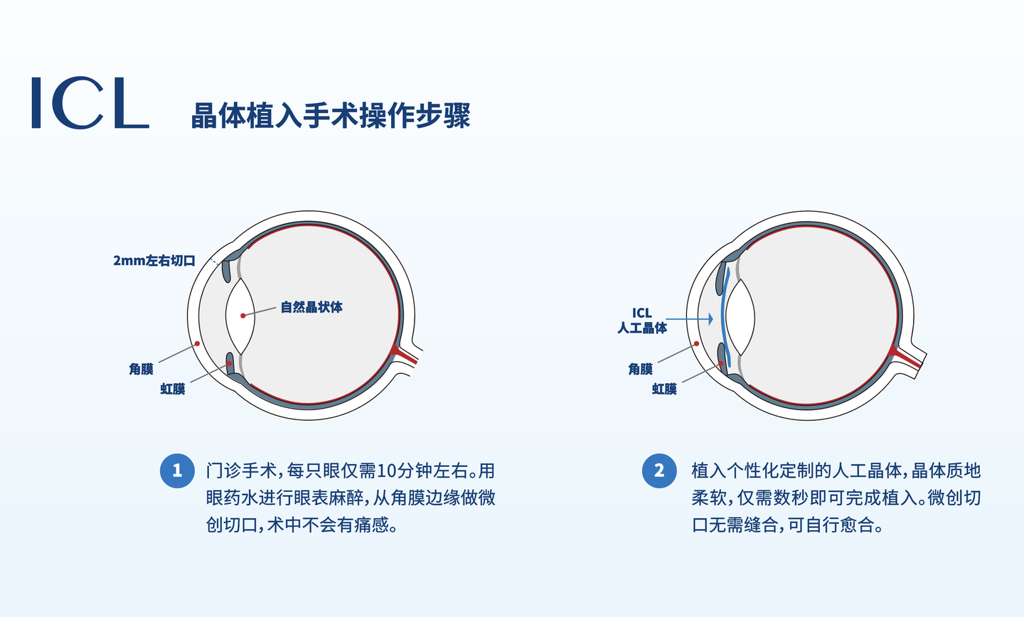 Icl晶体植入手术靠谱吗 并发症 后遗症 知乎 Icl晶体植入手术靠谱吗 并发症 后遗症 知乎
