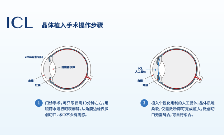 Icl晶体植入手术靠谱吗 并发症 后遗症 知乎 Icl晶体植入手术靠谱吗 并发症 后遗症 知乎