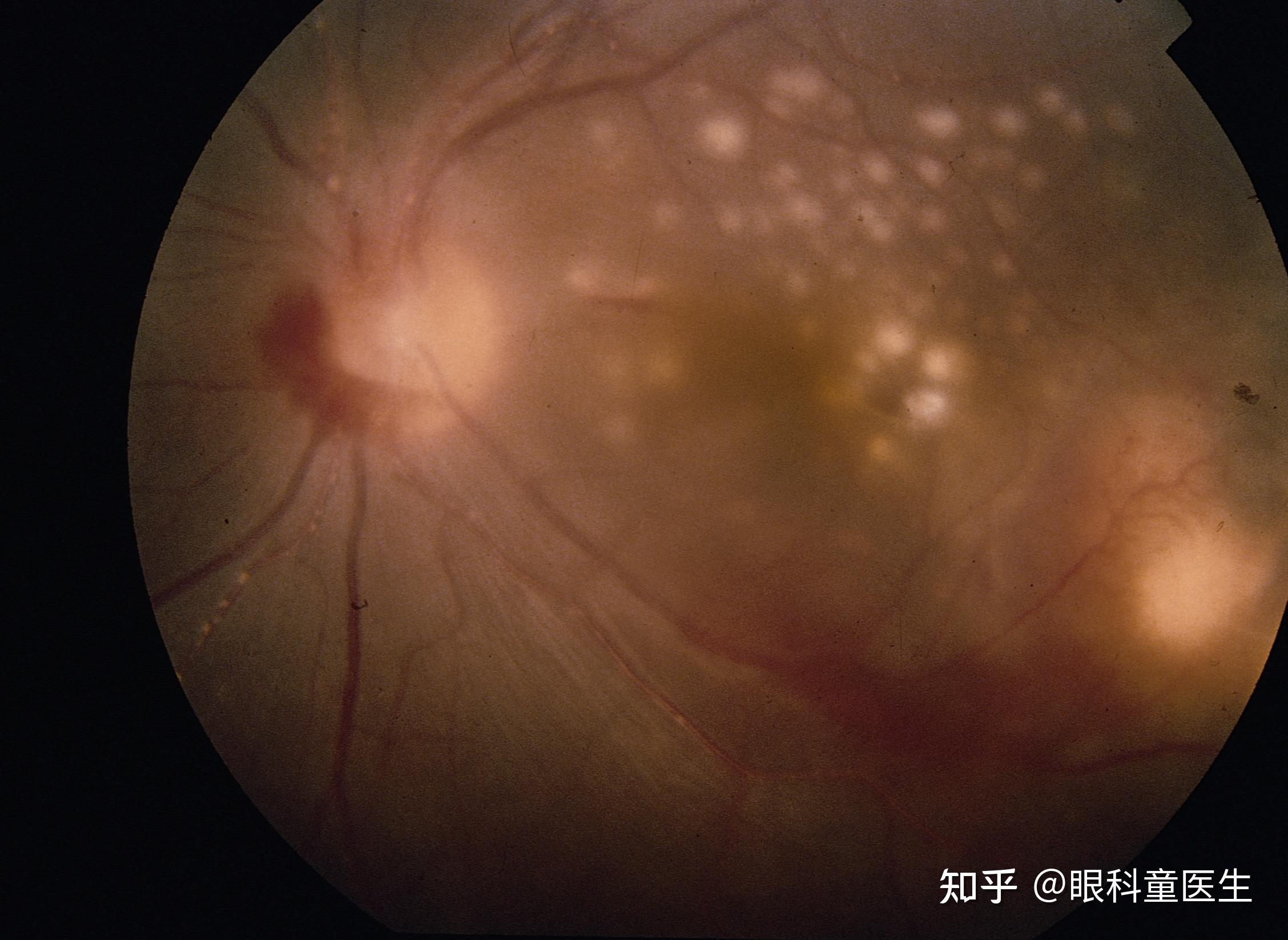 脉络膜的变性与营养不良性疾病——5、病理性近视的眼底改变 - 知乎