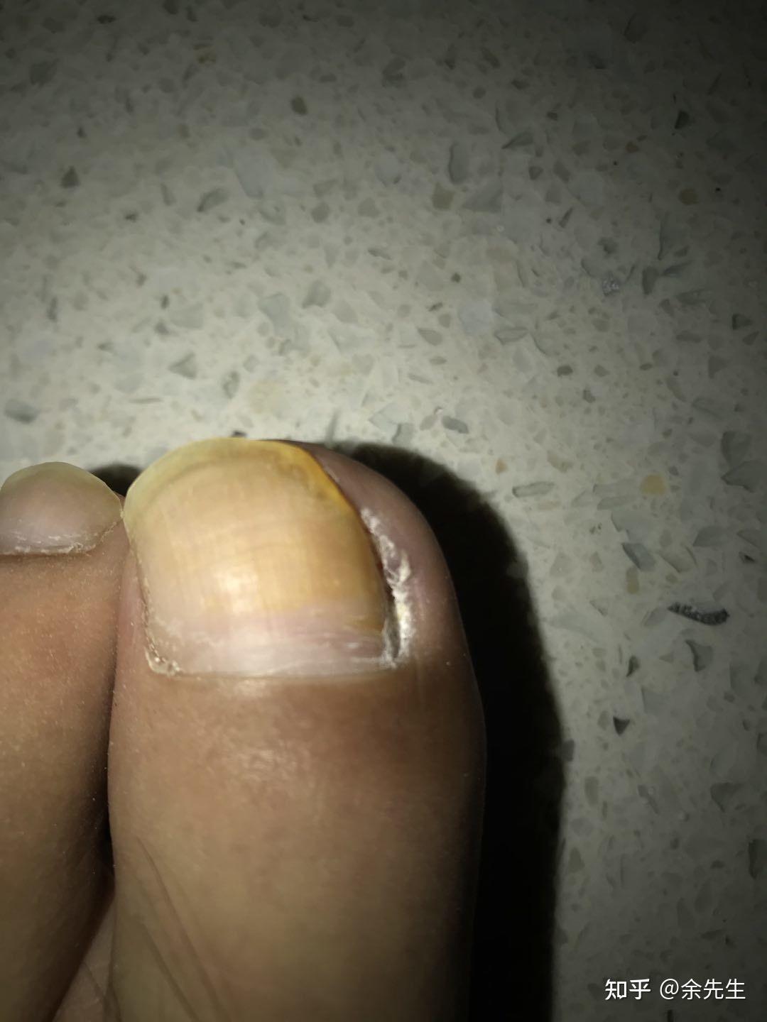 甲沟炎旁边长了个肉球见过吗?这种应该怎么消
