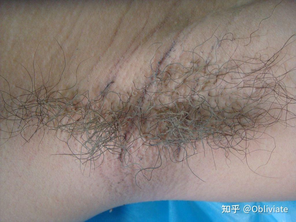 腋毛上有白色黄色的附着物,洗不掉,还有刺鼻的味道怎么办?