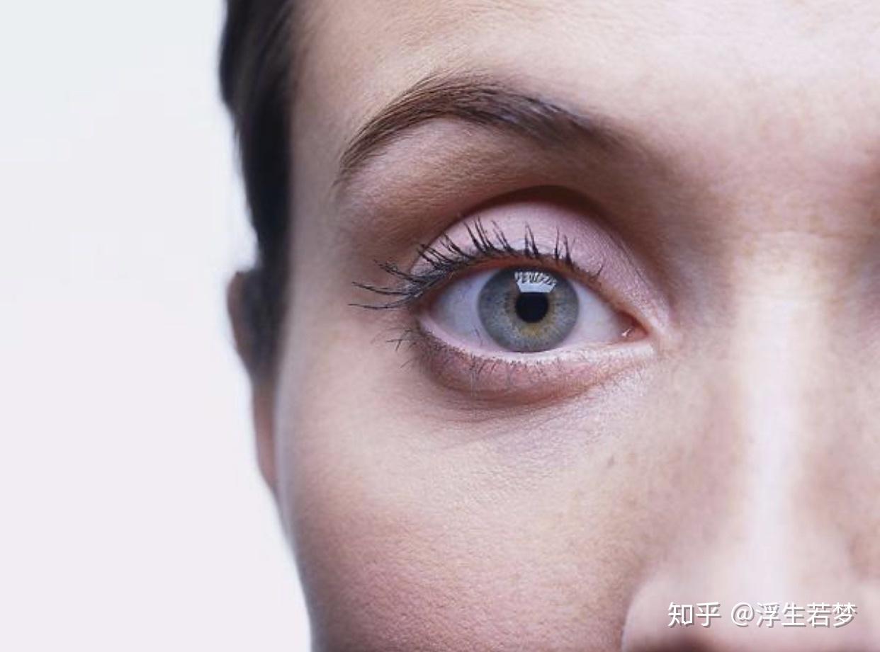 你是哪种黑眼圈？黑眼圈的成因，分类，预防与治疗全攻略 - 知乎