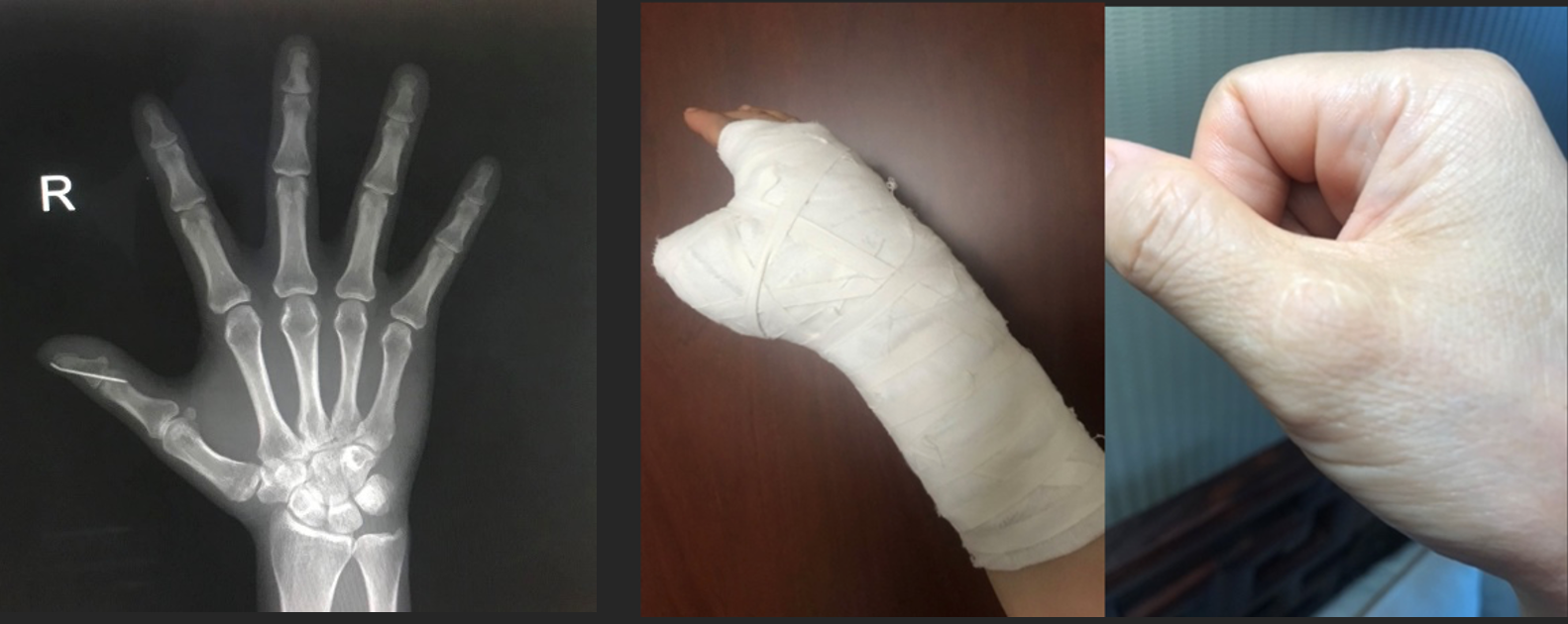 如果这根肌腱没有接好你就可以申办残疾证了