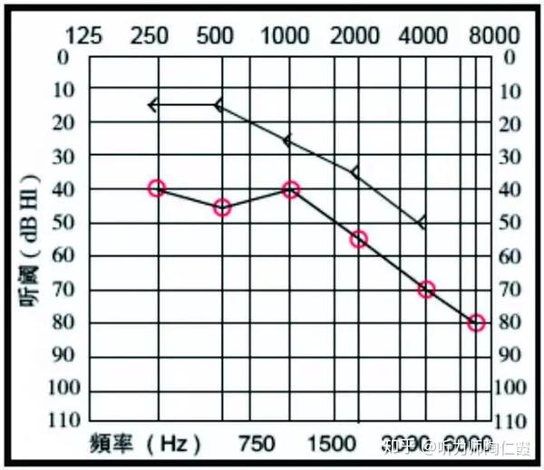 气导与骨导之间差异大于10db且骨导在正常范围之外的为混合型听力损失