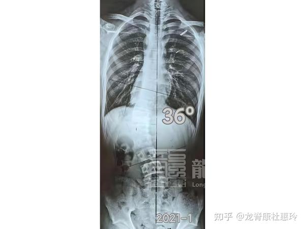 治疗仅仅半年,15岁男孩脊柱侧弯减少22°,剃刀背减少13° - 知乎
