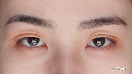 轻微的斜视有无非手术矫正的可能