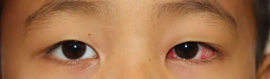 6月3日著名斜弱视专家郭新教授亲临西安会诊及手术名额有限