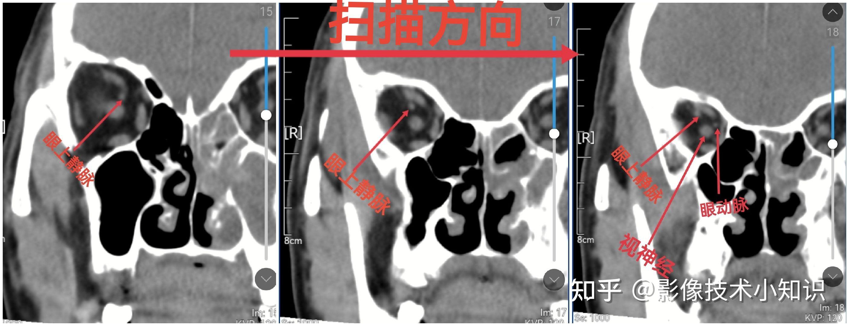 眼肌ct解剖图片