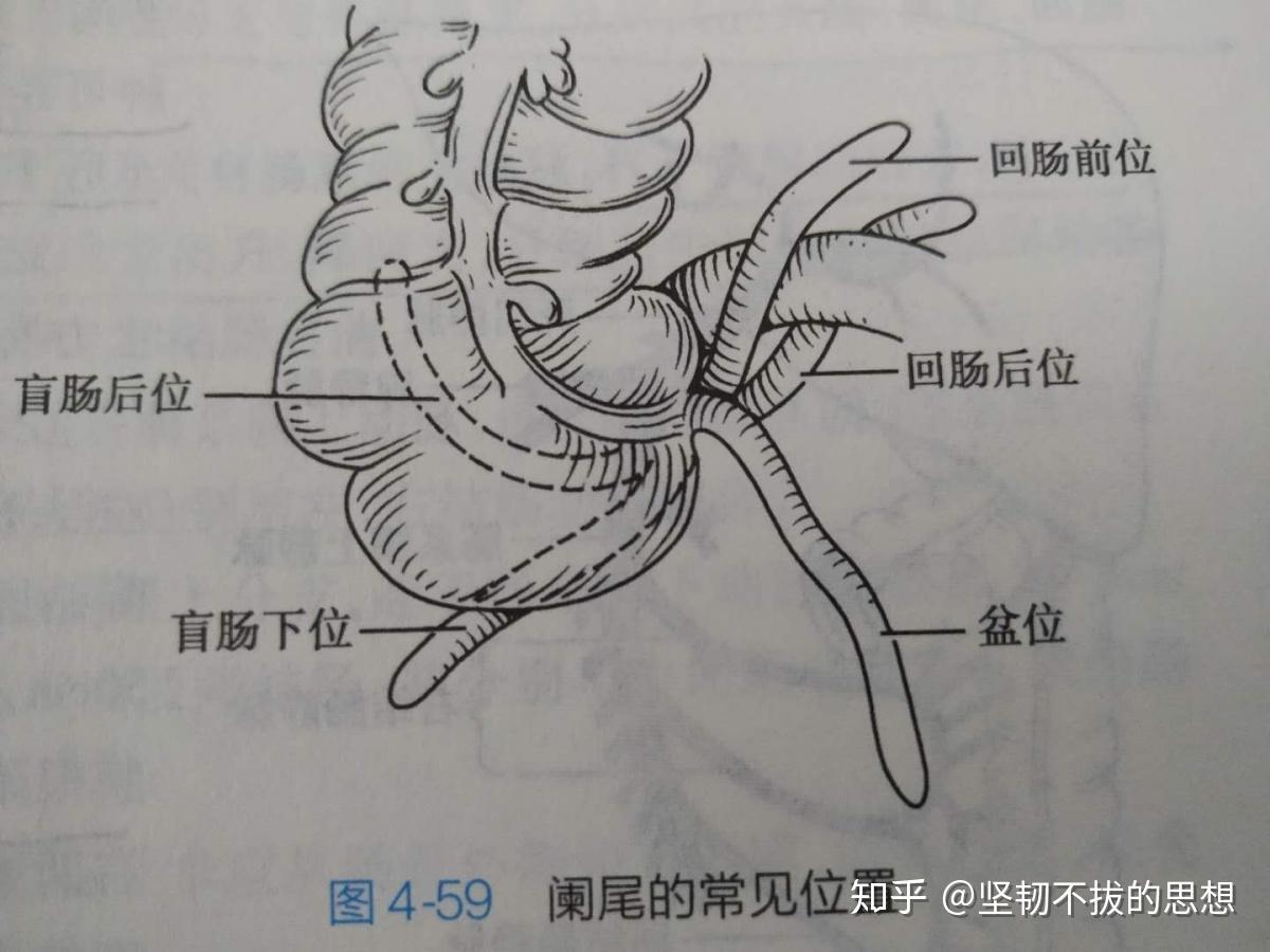 阑尾解剖结构绘图图片