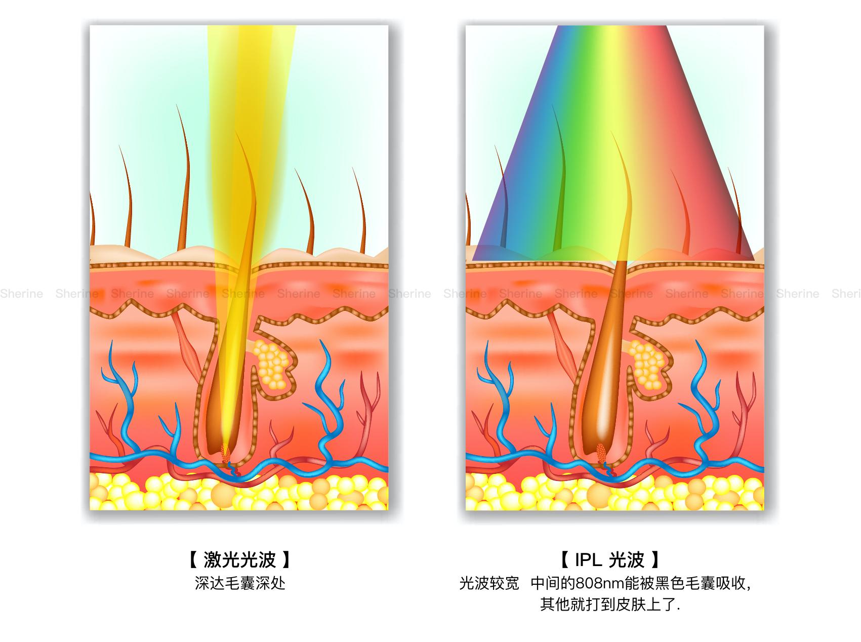 激光脱毛原理图片