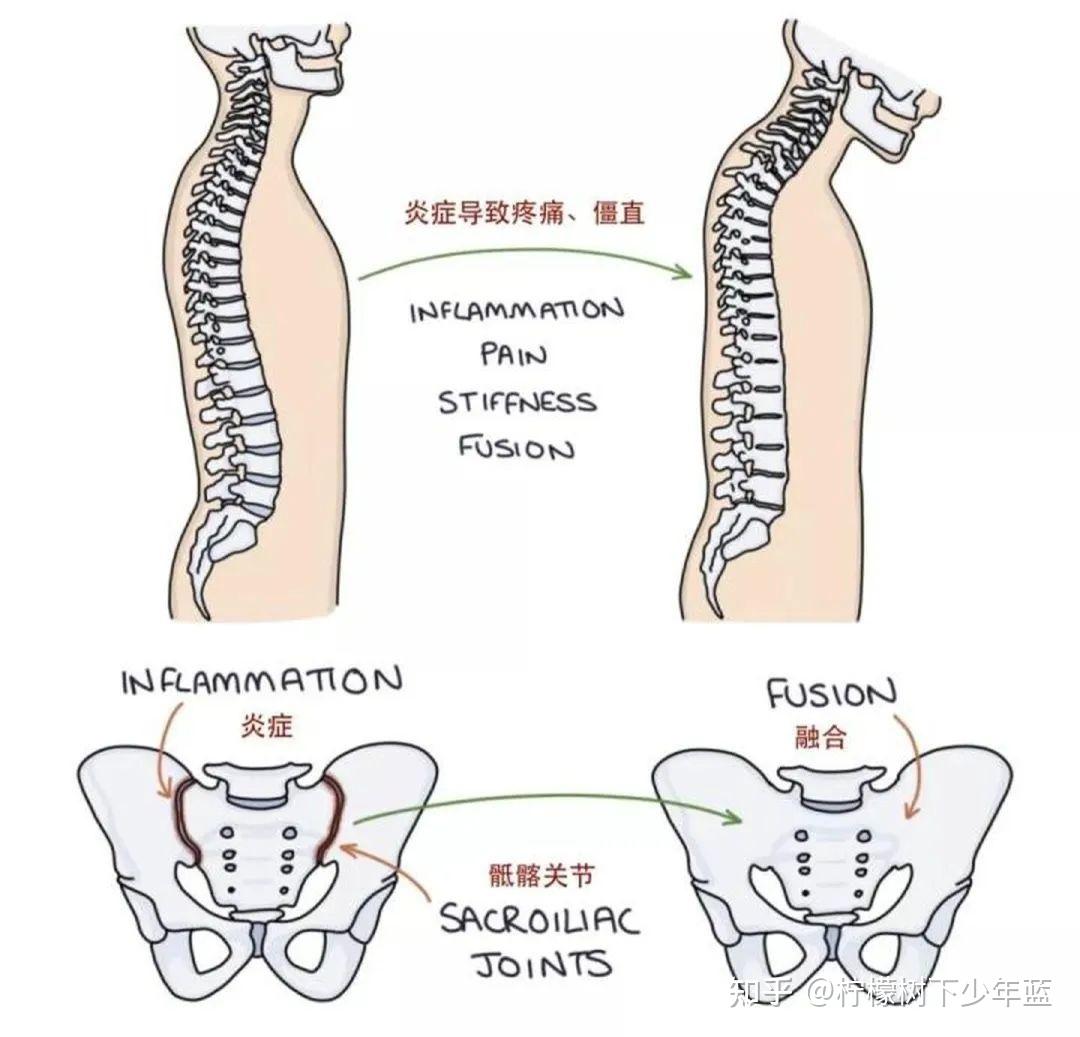 脊柱棘上韧带炎图片图片