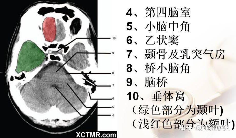 解剖&影像 ~ 脑实质ct断层解剖