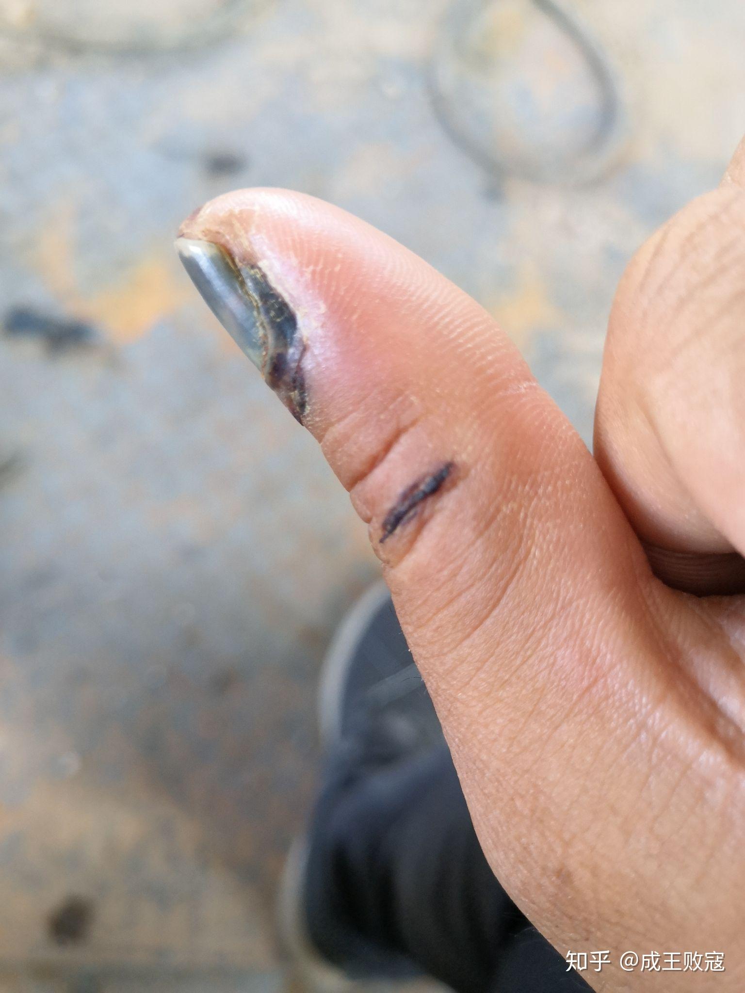 指甲受伤了 - 知乎