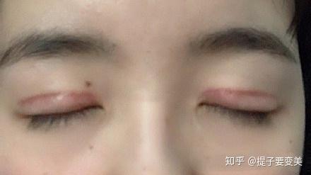双眼皮术后为什么会出现疤痕增生如何预防