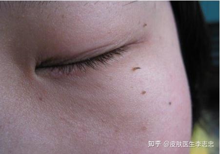 皮肤上长的小疙瘩竟是hpv感染?