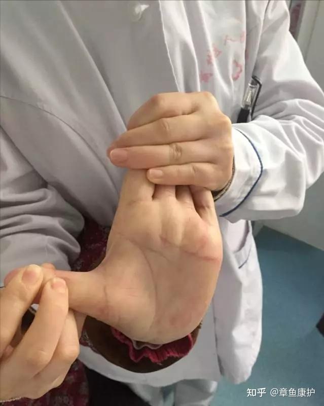 这些抗痉挛训练要坚持做,能解决大部分手指伸不直,僵硬的偏瘫问题