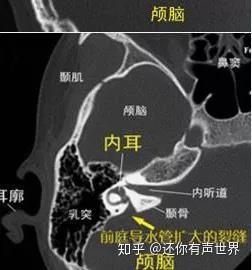 前庭导水管扩大\综合征的诊断与干预的再认识 - 知乎