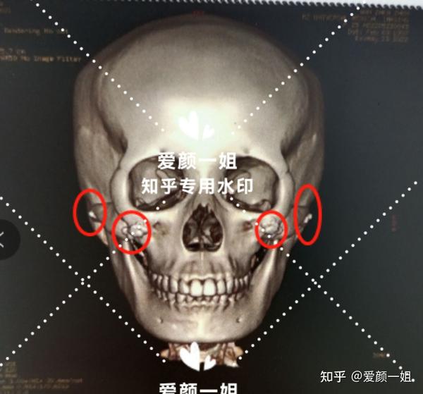 每日轮廓案例反馈||上海颧骨颧弓内推,颧弓依然外扩严重,推了一个寂寞~ - 知乎