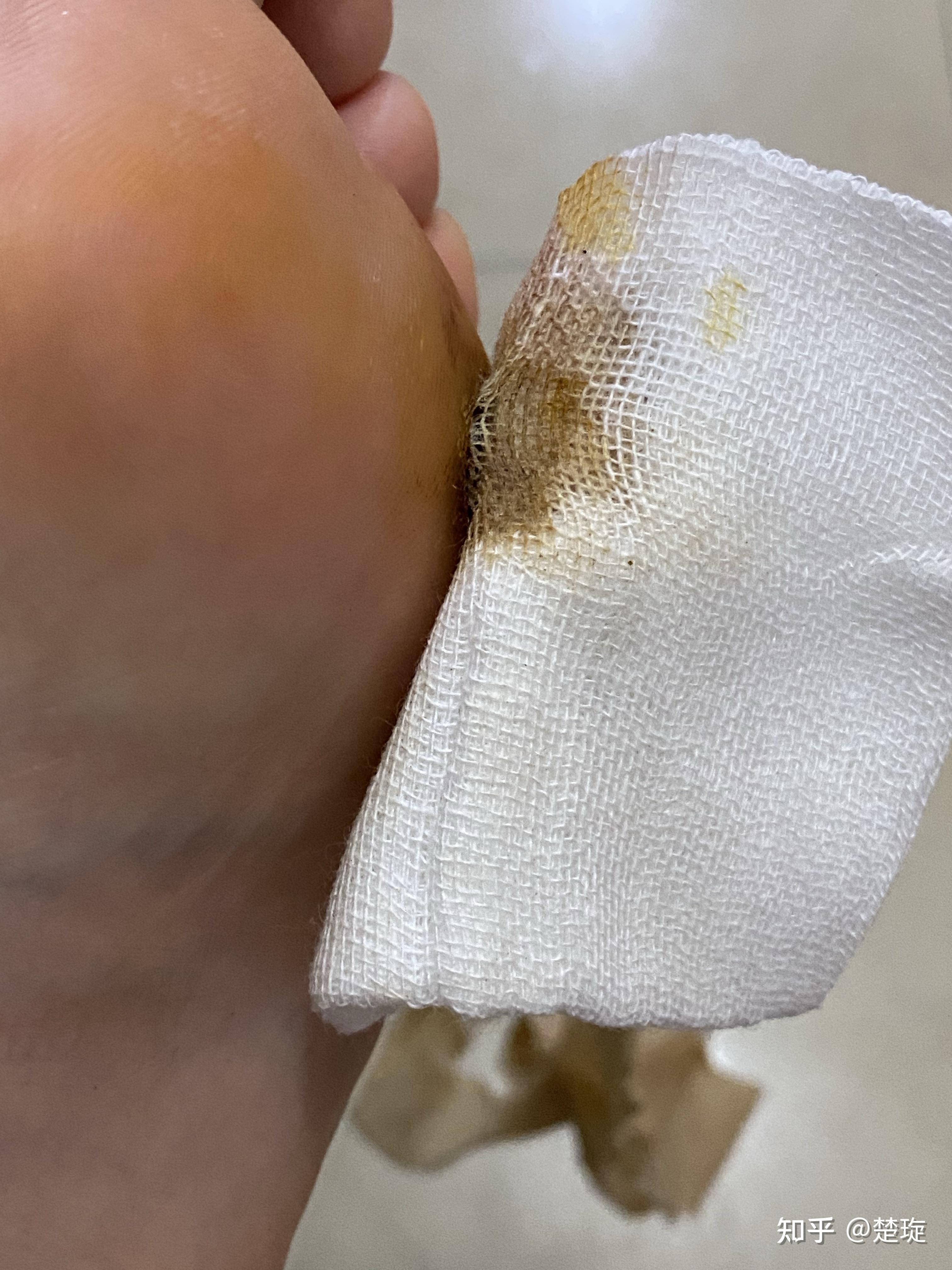 胼胝做完激光手术的效果