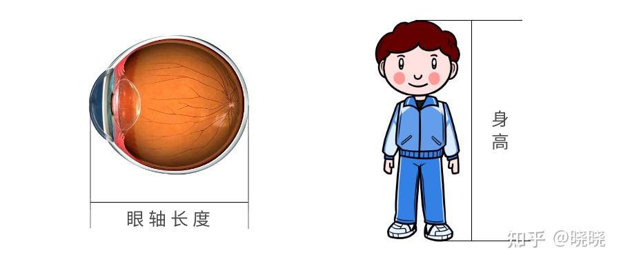 小朋友眼轴测量的重要性
